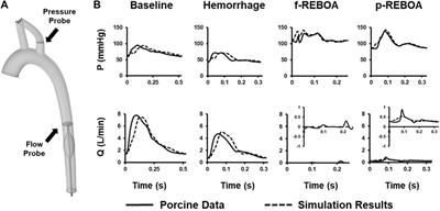 Development of a computational fluid dynamic model to investigate the hemodynamic impact of REBOA